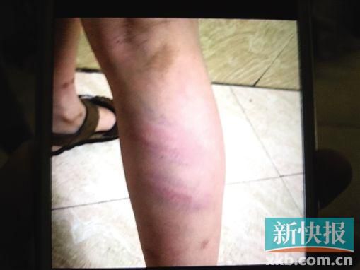 小宇腿部有明顯瘀痕。 翻拍自家屬手機(jī)