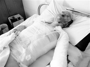 周小姐的頭、頸、軀干、四肢均被燒傷，其中面部燒傷最為嚴重。