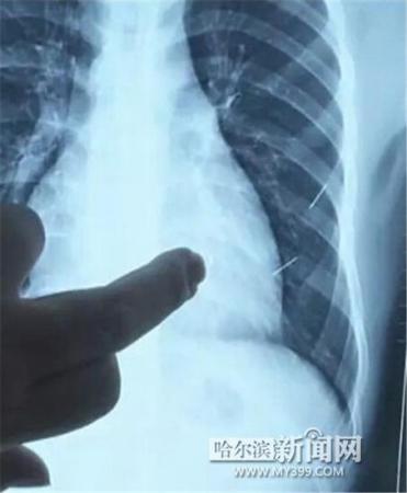 17歲少年體內(nèi)扎進4根鋼針 1根已插入心臟4厘米 17歲少年體內(nèi)扎進4根鋼針 1根已插入心臟4厘米