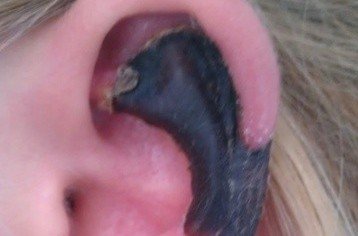 荷蘭女子旅游途中被蜘蛛咬，耳軟骨溶解變黑。