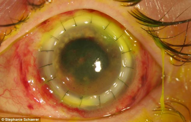 恐怖慎入！隱形眼鏡致英女子摘除眼球