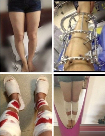 矯正"O型腿"手術全過程