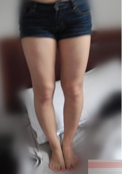 矯正"O型腿"手術全過程