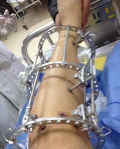 矯正"O型腿"手術全過程