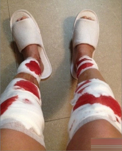 矯正"O型腿"手術全過程