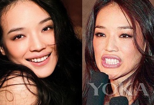 牙齒凸出，口輪肌過(guò)于松弛