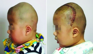 術(shù)前（左），術(shù)后（右）