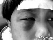 6月2日，網(wǎng)曝渭南市臨渭區(qū)一不滿5歲的女童遭奶奶毆打，眼圈青腫，引起網(wǎng)友關(guān)注，但孩子父母和爺爺均稱是摔倒導(dǎo)致。相關(guān)部門介入調(diào)查發(fā)現(xiàn)確為奶奶毆打所致，鑒于其身體原因已進(jìn)行批評教育。