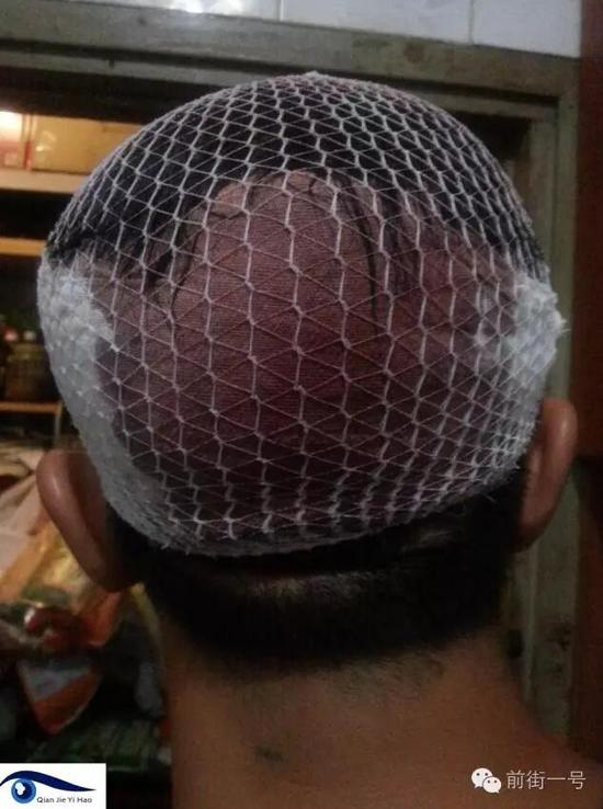 李律師受傷后縫合三針。