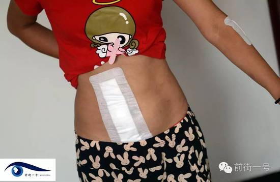 小金腹部的傷口。