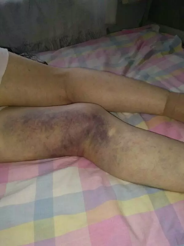 八旬老太被美容院洗腦交7萬(wàn)元 腿沒治好反病倒