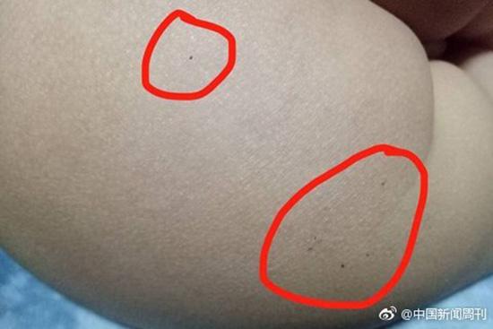 據(jù)多名紅黃藍(lán)(新天地分園)家長反映，孩子腿部、屁股、腋下出現(xiàn)針眼。