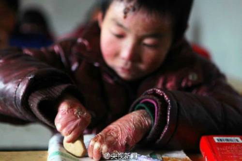 男孩皮膚一碰就破 裹衛(wèi)生紙堅持上學 男孩皮膚一碰就破 裹衛(wèi)生紙堅持上學