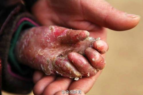 男孩皮膚一碰就破 裹衛(wèi)生紙堅持上學 男孩皮膚一碰就破 裹衛(wèi)生紙堅持上學