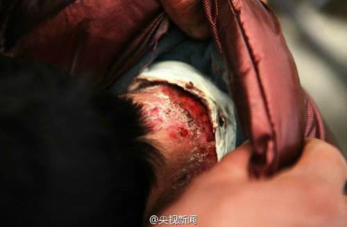 男孩皮膚一碰就破 裹衛(wèi)生紙堅持上學 男孩皮膚一碰就破 裹衛(wèi)生紙堅持上學