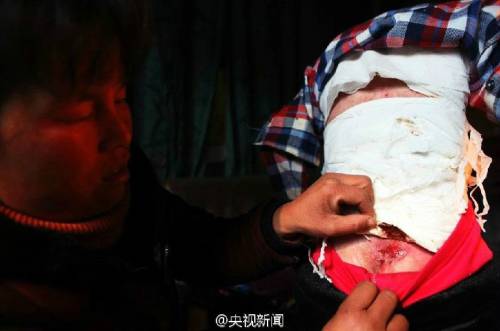 男孩皮膚一碰就破 裹衛(wèi)生紙堅持上學 男孩皮膚一碰就破 裹衛(wèi)生紙堅持上學