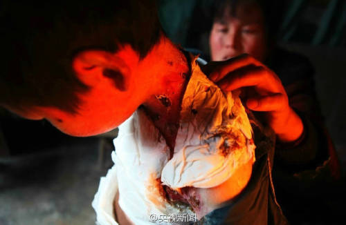 男孩皮膚一碰就破 裹衛(wèi)生紙堅持上學 男孩皮膚一碰就破 裹衛(wèi)生紙堅持上學