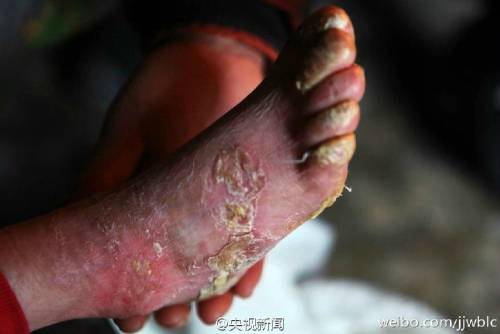 男孩皮膚一碰就破 裹衛(wèi)生紙堅持上學 男孩皮膚一碰就破 裹衛(wèi)生紙堅持上學