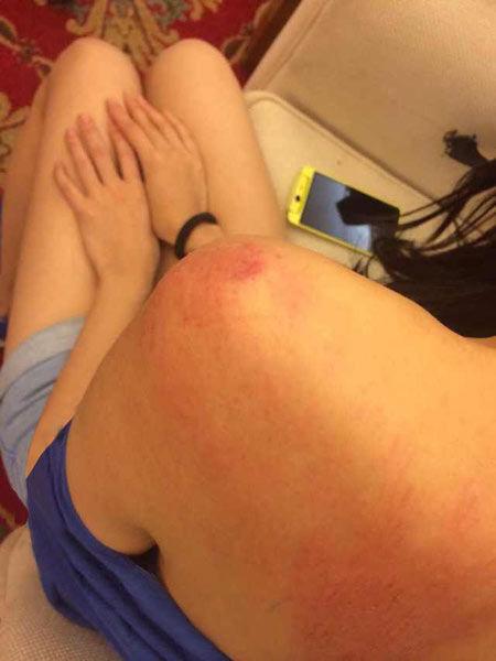 “跑男”真的很拼！baby朋友圈曬后背紅腫照