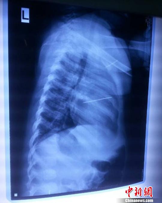 河南心臟被扎針女嬰術(shù)后尚未脫險(xiǎn)家人渴求真相 河南心臟被扎針女嬰術(shù)后尚未脫險(xiǎn)家人渴求真相