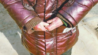 長(zhǎng)期受損的手指，已經(jīng)長(zhǎng)在了一起。