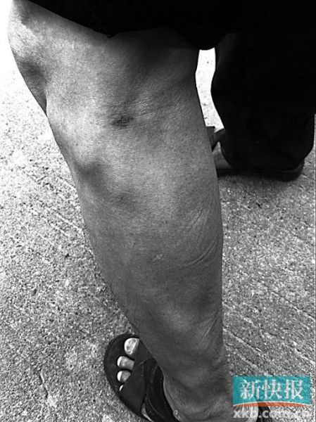 傷者身上遺留的彈痕。