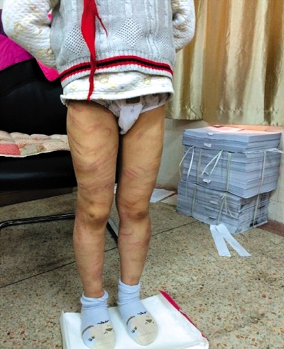 4月3日晚,微博網(wǎng)友“@朝廷半日閑”發(fā)圖文微博展示男童被虐待的慘狀。 微博截圖 4月3日晚,微博網(wǎng)友“@朝廷半日閑”發(fā)圖文微博展示男童被虐待的慘狀。 微博截圖