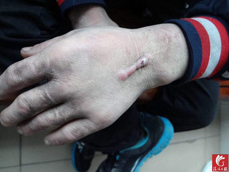 被發(fā)現(xiàn)男子手上的傷疤。