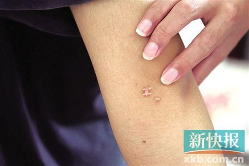 取出針后李星兒手臂留下了傷口。新快報(bào)記者 張國(guó)鋒/攝