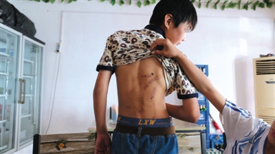 　昨日，奶西村，被打的小剛后背上條條瘀痕依然明顯。