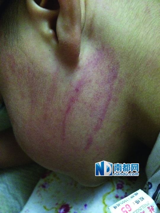 小逸臉上淤痕清晰可見(jiàn)。