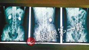 ▲片子上能看見巨大結(jié)石