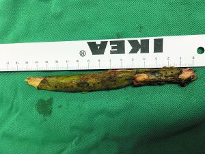 插入男子腦內(nèi)的樹枝。