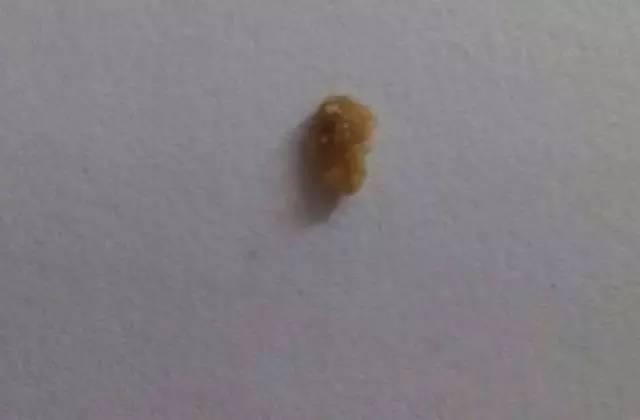 55歲大爺因愛吃豆腐 體內(nèi)取出420顆結石 55歲大爺因愛吃豆腐 體內(nèi)取出420顆結石